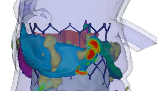 Image from an AI predictive modeling program for the treatment of structural heart diseases.